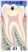 虫歯の段階C1