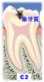 虫歯の段階C2