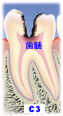 虫歯の段階C3