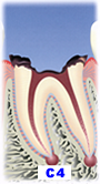 虫歯の段階C4